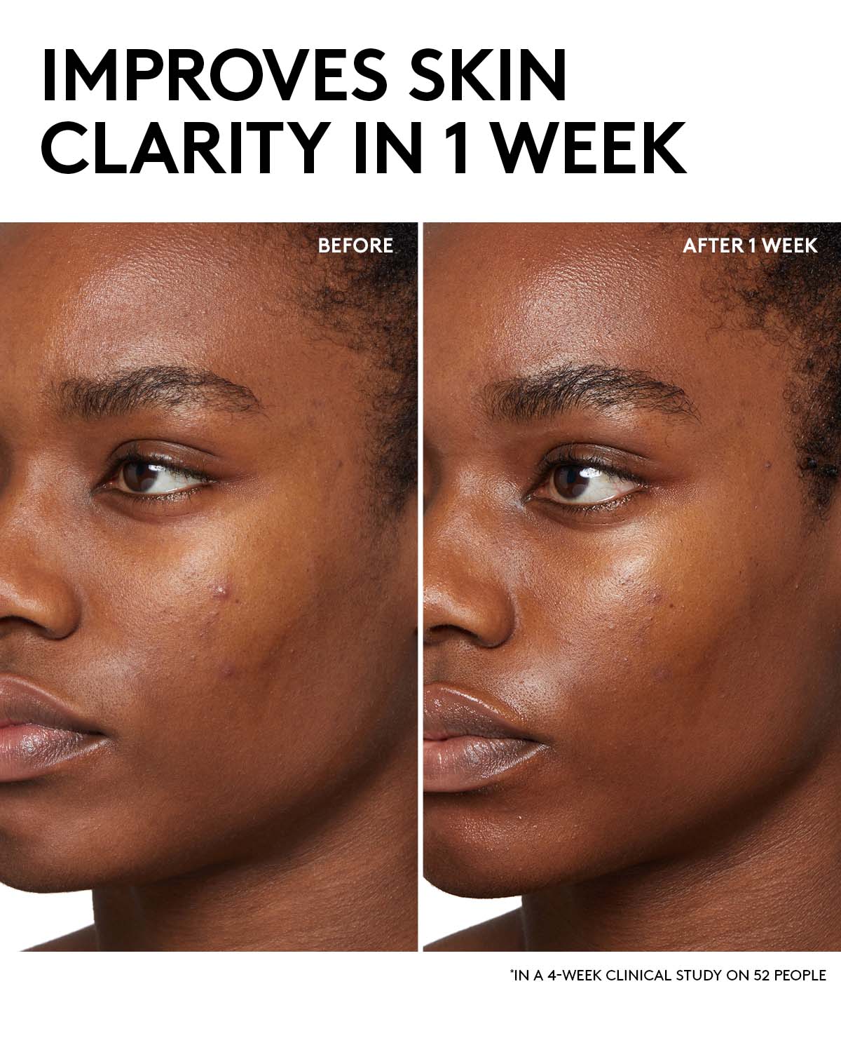 Cherry Dub Salicylic Acid Toner for Oily Skin & Pores