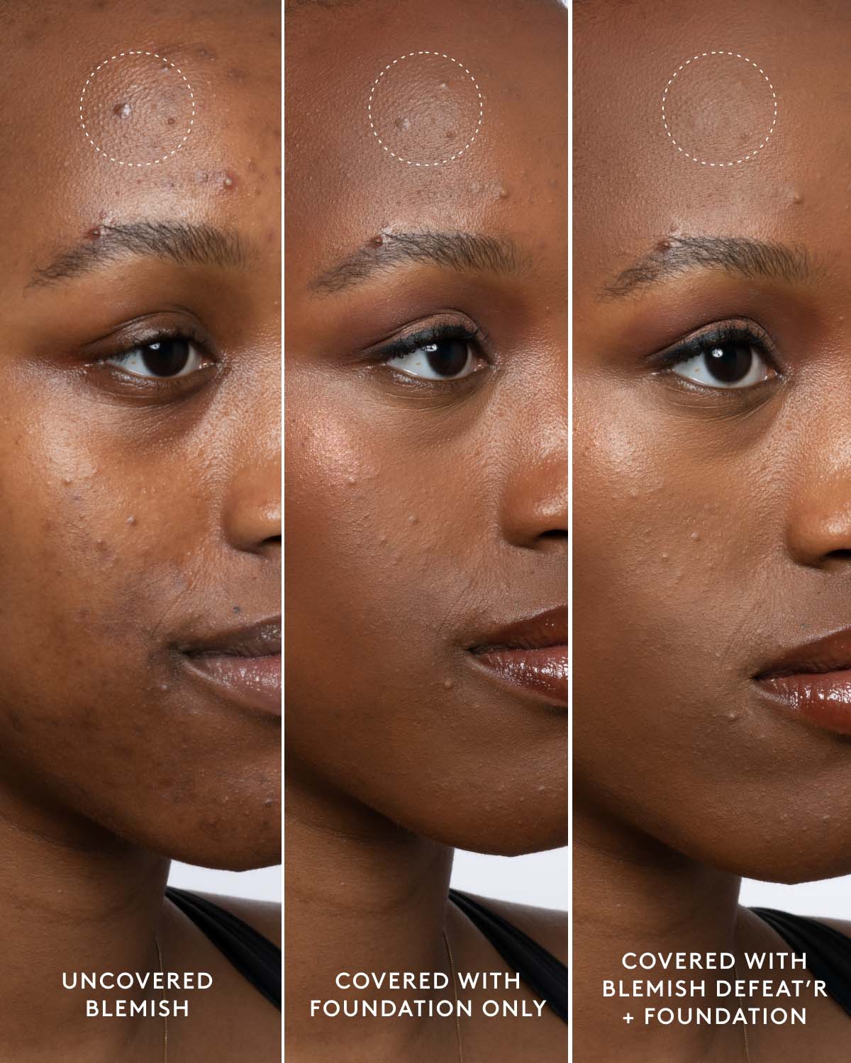 Salicylic Acid Blemish Concealer Duo - Seal N Conceal Spot Coverage